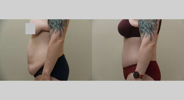 Tummy Tuck: Image #1234