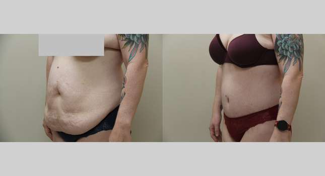 Tummy Tuck: Image #1235