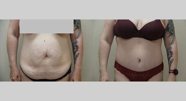 Tummy Tuck: Image #1236