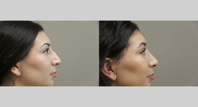 Nose Surgery: Image #1237