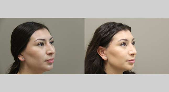 Nose Surgery: Image #1238