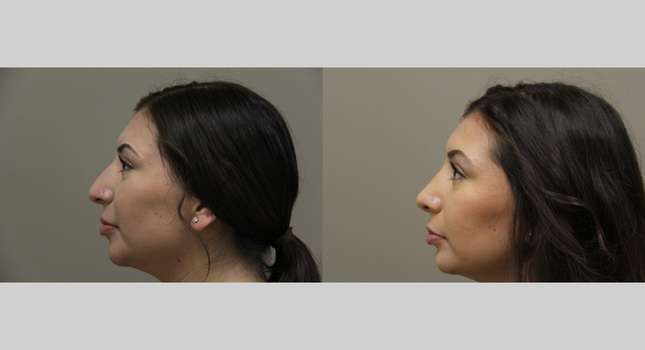Nose Surgery: Image #1239