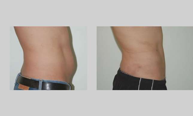 Liposuction: Image #124