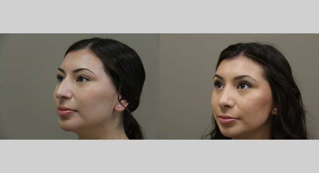 Nose Surgery: Image #1240