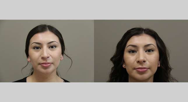 Nose Surgery: Image #1241