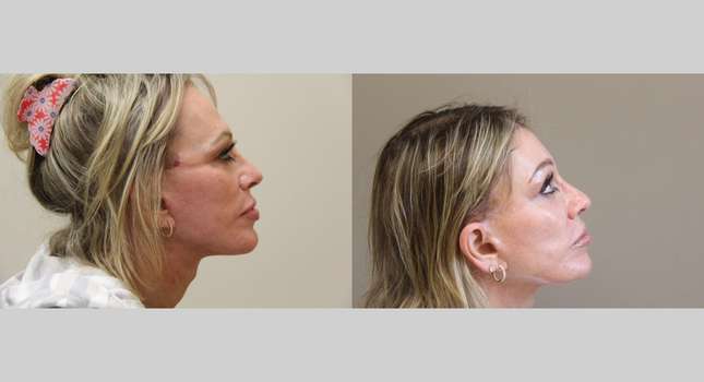 Forehead and Brow Lift: Image #1247
