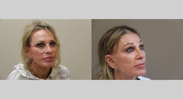 Forehead and Brow Lift: Image #1248