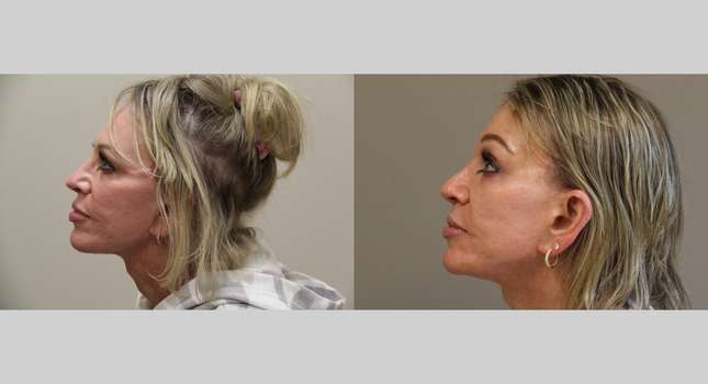 Forehead and Brow Lift: Image #1249