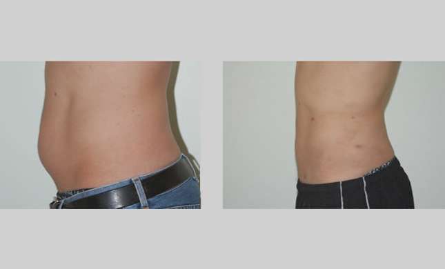 Liposuction: Image #125