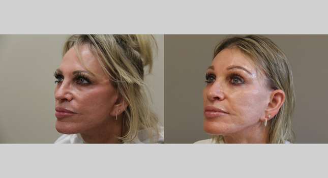 Forehead and Brow Lift: Image #1250