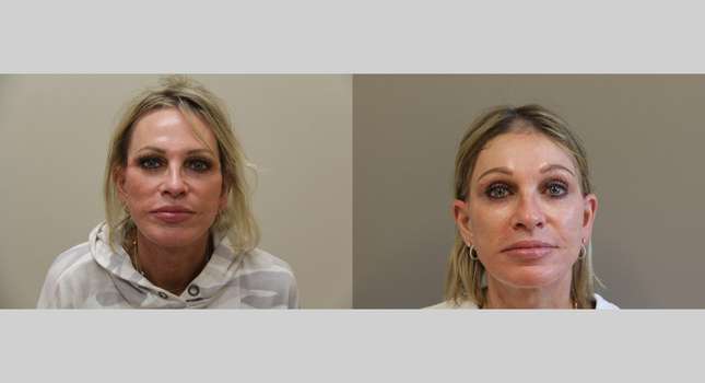 Forehead and Brow Lift: Image #1251