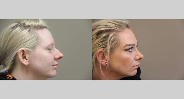 Nose Surgery: Image #1252