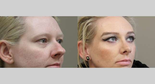 Nose Surgery: Image #1253