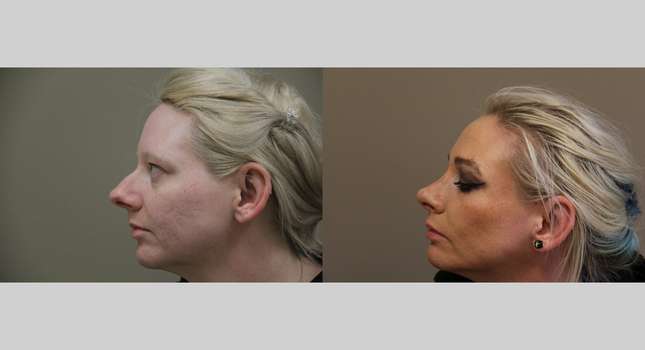 Nose Surgery: Image #1254