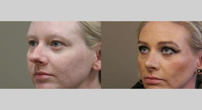 Nose Surgery: Image #1255