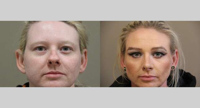 Nose Surgery: Image #1256
