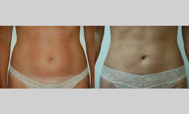 Liposuction: Image #126