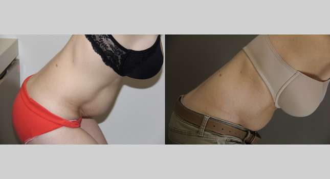 Tummy Tuck: Image #1263