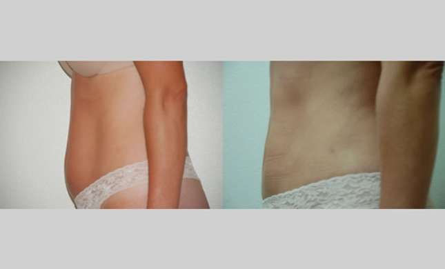 Liposuction: Image #127