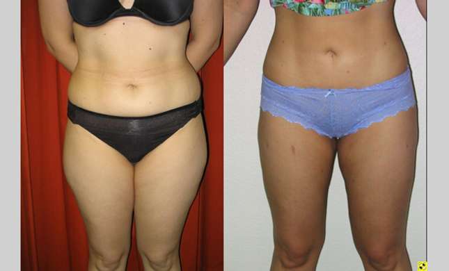 Liposuction: Image #128