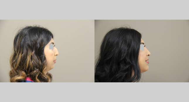 Nose Surgery: Image #1286