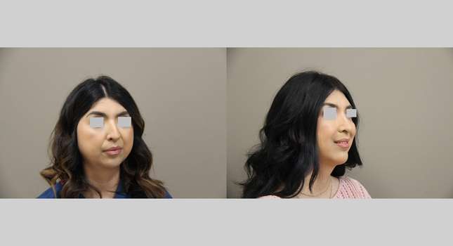 Nose Surgery: Image #1287