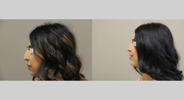 Nose Surgery: Image #1288