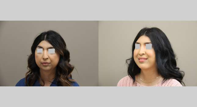 Nose Surgery: Image #1289