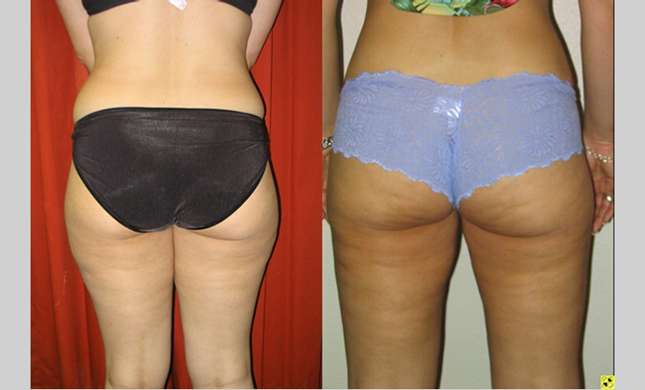Liposuction: Image #129