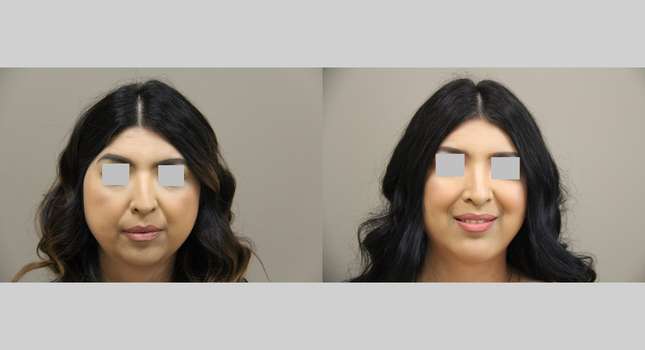 Nose Surgery: Image #1290