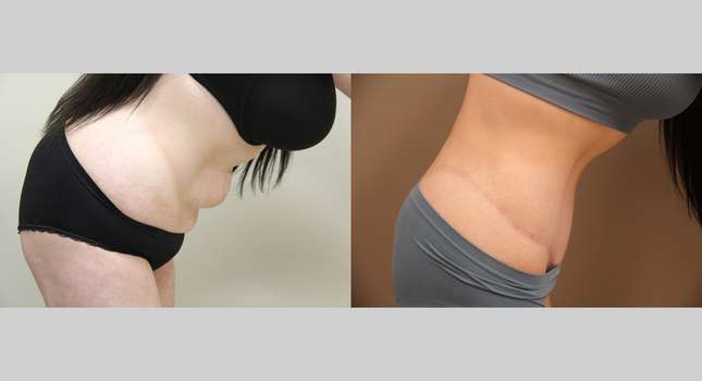 Body Lift: Image #1296