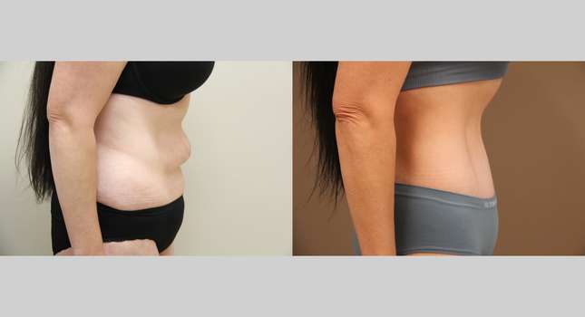 Body Lift: Image #1297
