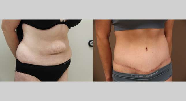 Body Lift: Image #1298