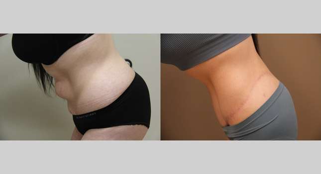 Body Lift: Image #1299