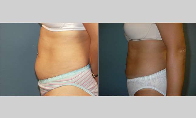 Liposuction: Image #130