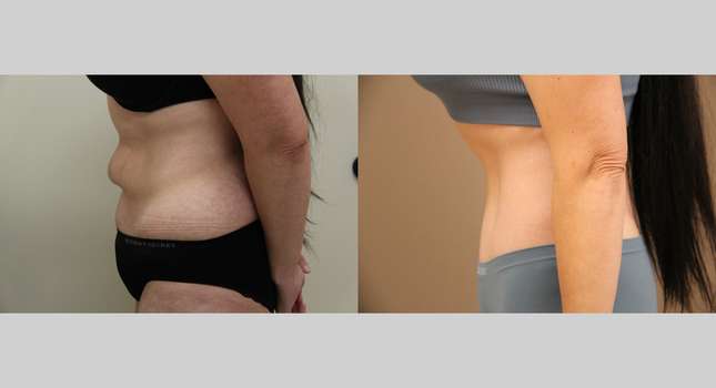 Body Lift: Image #1300