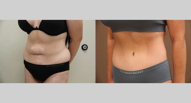 Body Lift: Image #1301