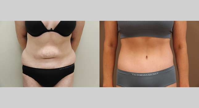 Body Lift: Image #1302