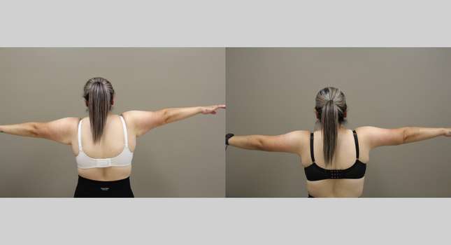 Upper Arm Lift: Image #1303