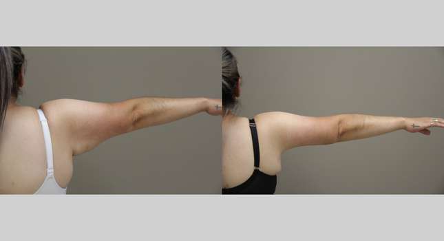 Upper Arm Lift: Image #1304