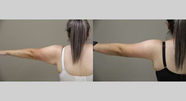 Upper Arm Lift: Image #1305