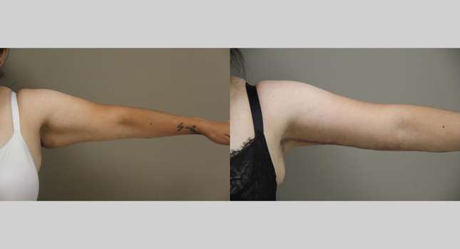 Upper Arm Lift: Image #1306