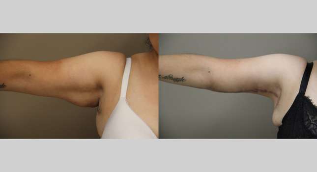 Upper Arm Lift: Image #1307