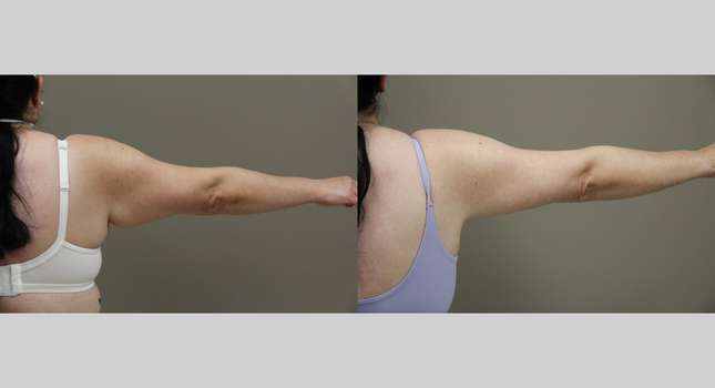 Upper Arm Lift: Image #1308