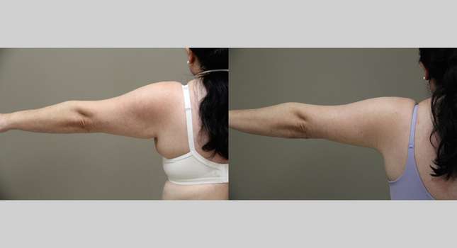 Upper Arm Lift: Image #1309