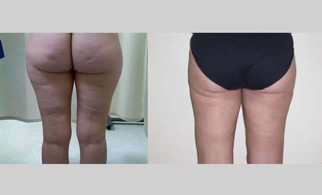 Liposuction: Image #131