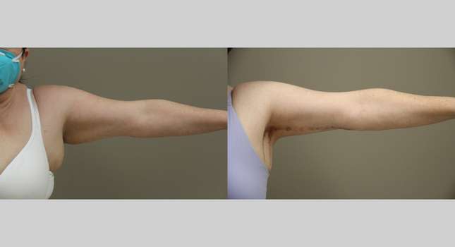 Upper Arm Lift: Image #1310