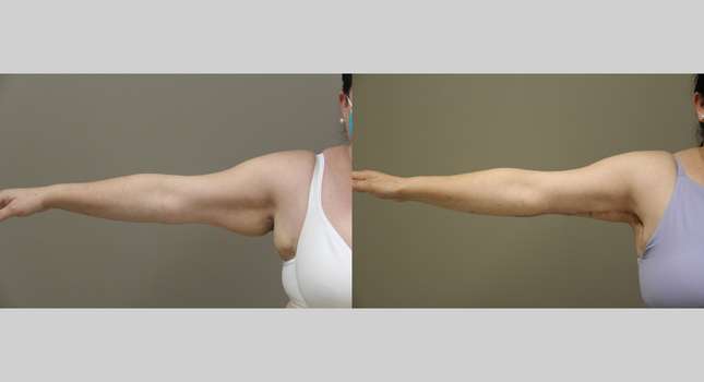Upper Arm Lift: Image #1311