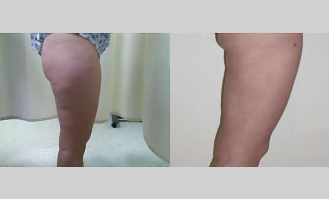 Liposuction: Image #132