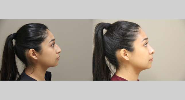 Nose Surgery: Image #1322